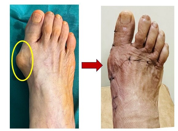 Mumbai Suburbs Get Advanced Minimally Invasive Bunion Surgery At Borivali Hospital