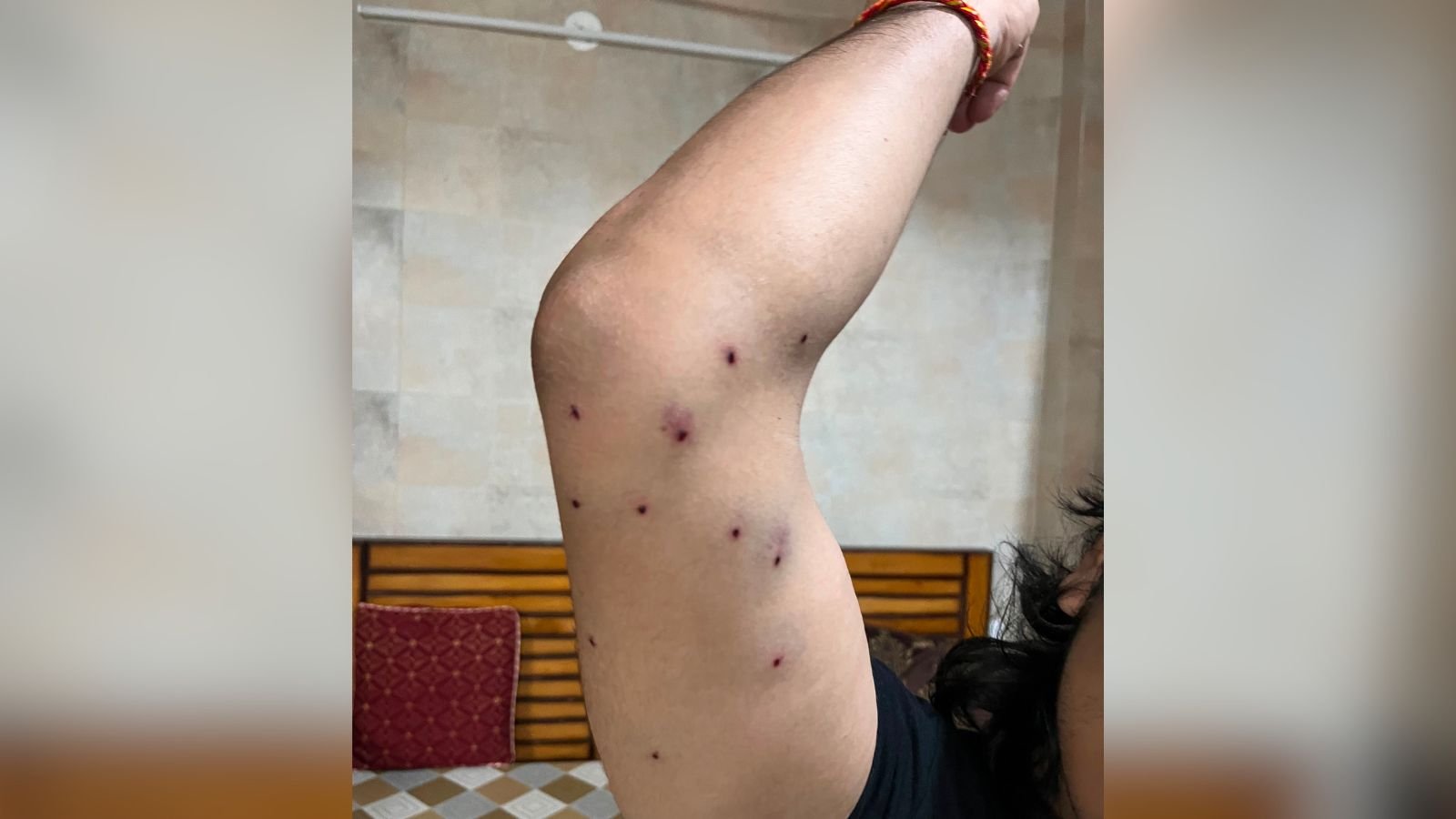 ‘30 pellets still inside my body’: Journalist hurt in CJP protest seeks compensation