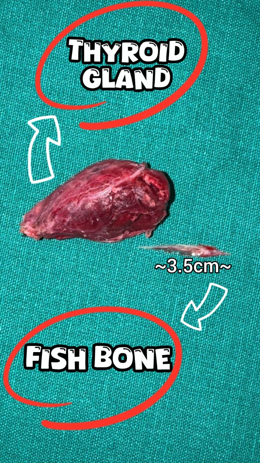 Mumbai Surgeons Remove Fish Bone Lodged Inside 11-Year-Old Girl's Thyroid Gland